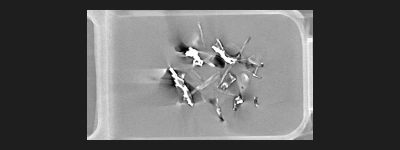 Inclusion de corps étranger détectée par imagerie 3D en tomographie rayon x